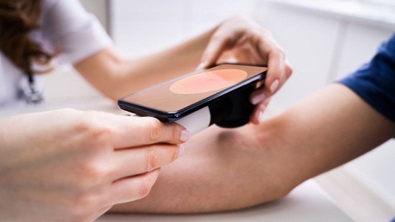 The power of self-examination and early skin cancer detection