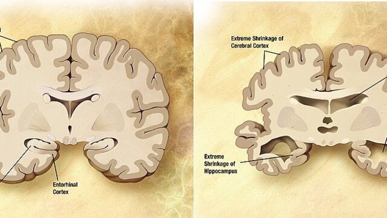 Outdoor Light Exposure Linked to Elevated Alzheimer’s Risk