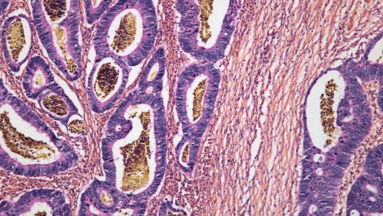 A New Immune Treatment May Work Against Several Cancer Types